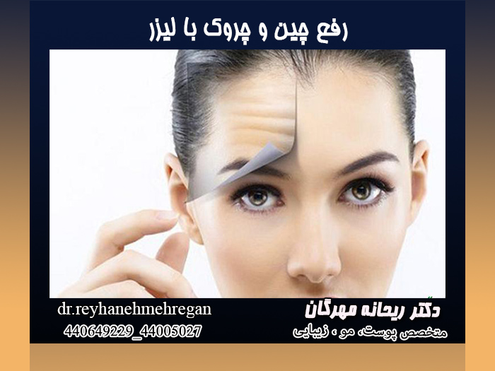 رفع چین و چروک با لیزر