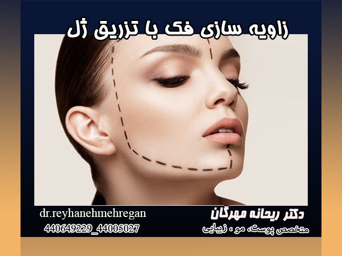 زاویه سازی فک با تزریق ژل