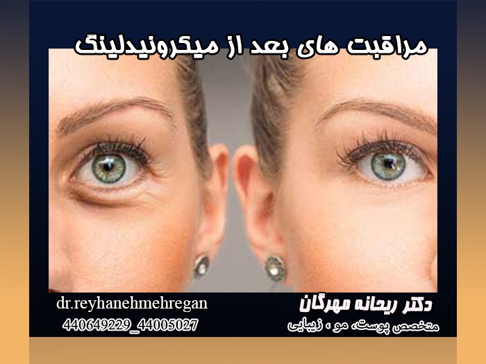 مراقبت های بعد از میکرونیدلینگ