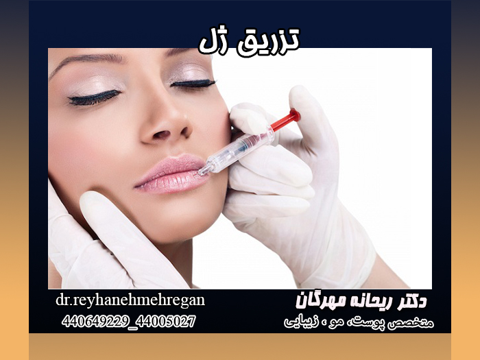 تزریق ژل لب