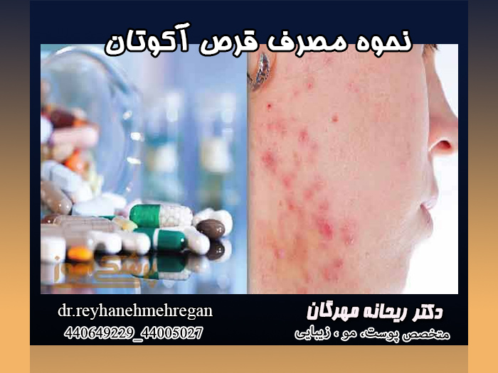 نحوه-مصرف-قرص-آکوتان