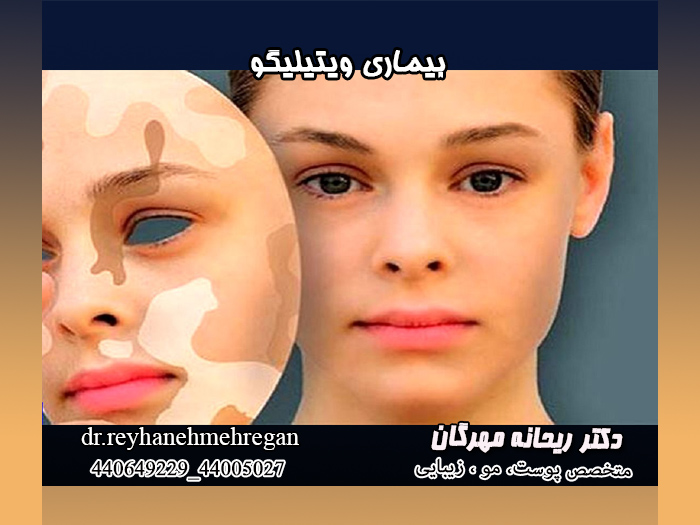بیماری ویتیلیگو