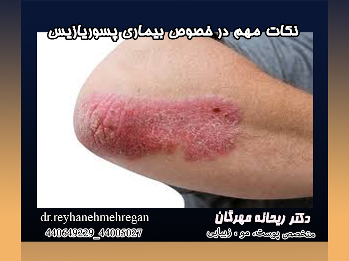 نکات مهم در خصوص بیماری پسوریازیس