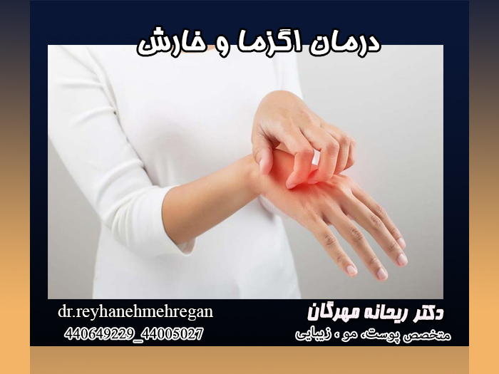 درمان اگزما و خارش