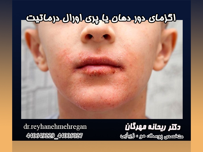 اگزمای دور دهان یا پری اورال درماتیت