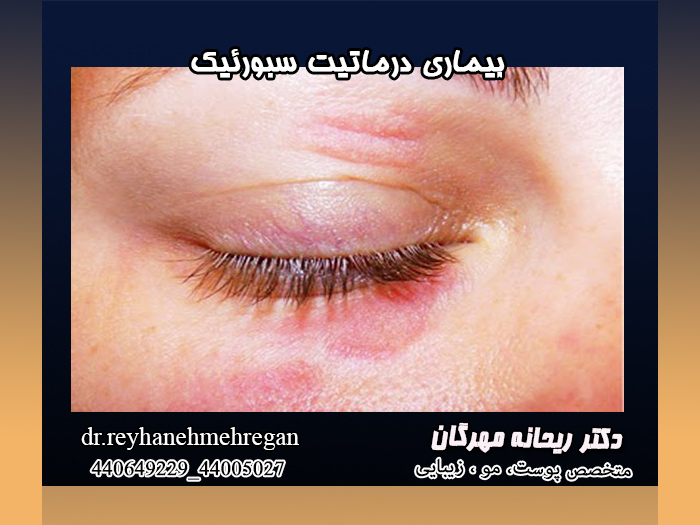 بیماری-درماتیت-سبورئیک