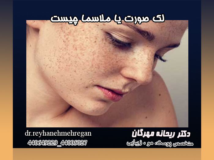 لک صورت یا ملاسما چیست
