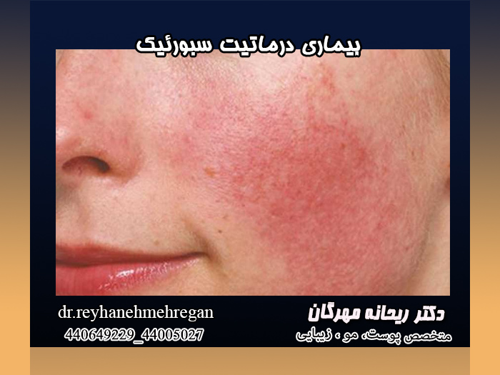 بیماری درماتیت سبورئیک (اگزمای پوسته دهنده)