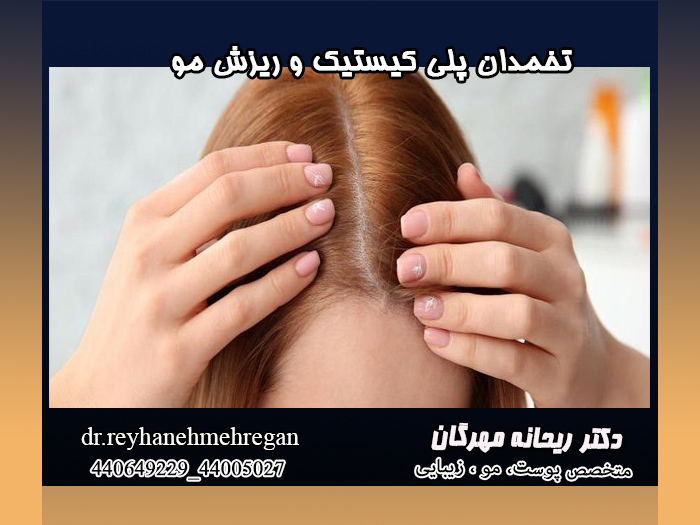 تخمدان پلیکیستیک و ریزش مو؛ آیا موها دوباره رشد میکنند؟