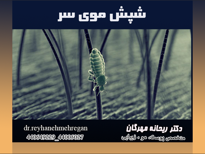 نمایی از شپش موی سر
