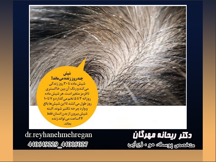 نکات ضروری شپش موی سر