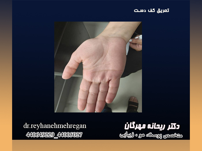 تعریق کف دست