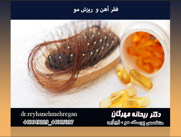 فقر آهن و ریزش مو