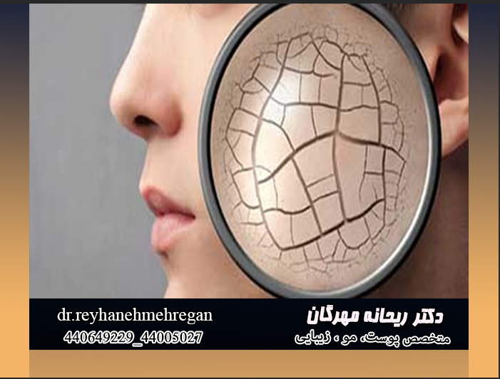 پوست خشک شده