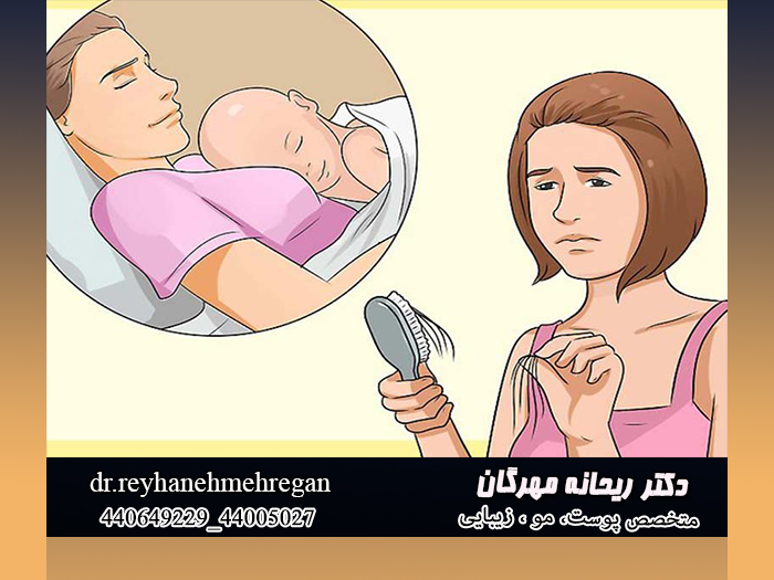 شیردهی عامل ریزش مو
