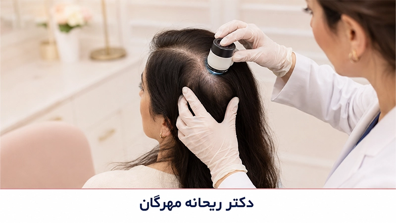 ریزش موی هورمونی و ارثی در زنان