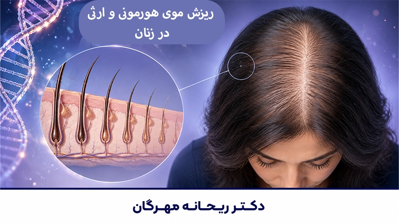 ریزش موی هورمونی و ارثی در زنان