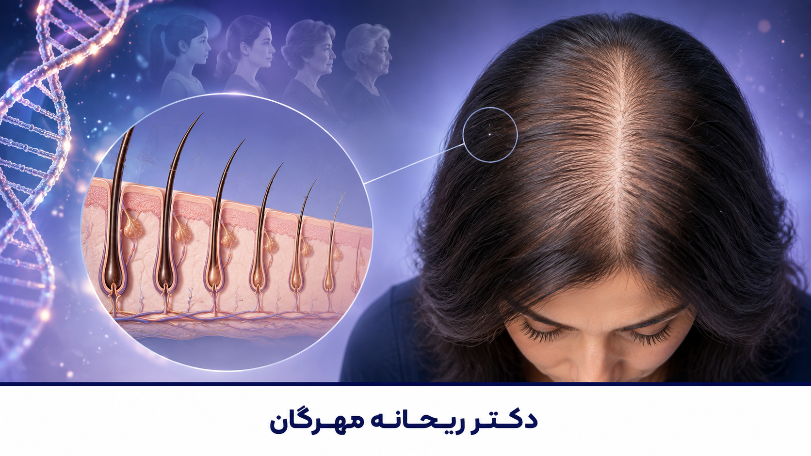 ریزش موی هورمونی و ارثی در زنان؛ چگونه علت اصلی ریزش مو را تشخیص دهیم؟