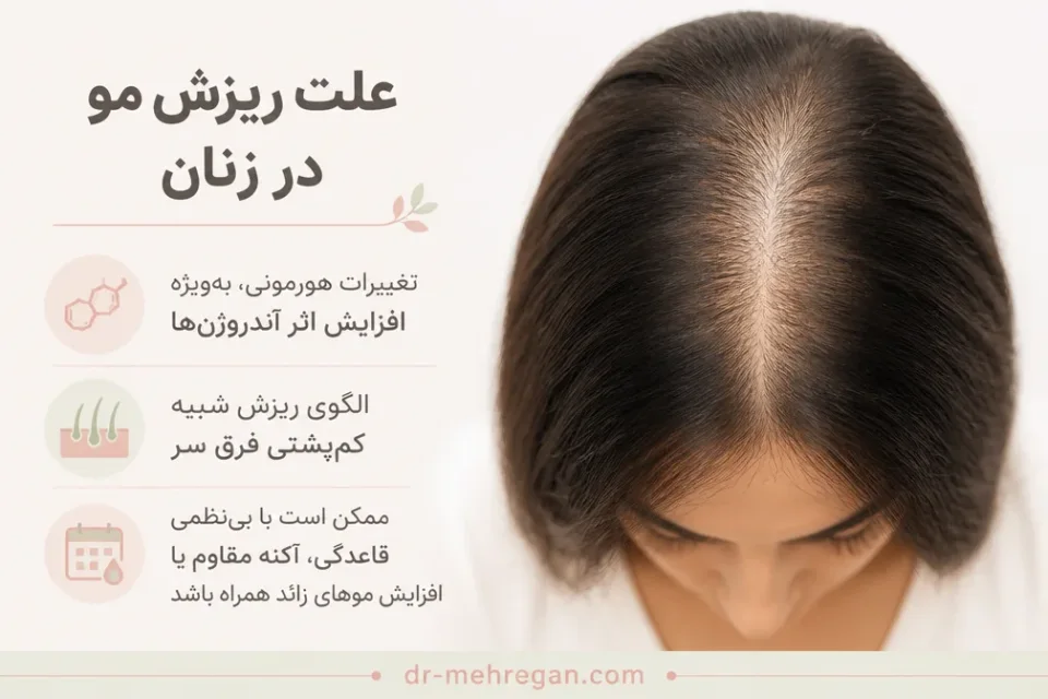 نمای توضیحی درباره تخمدان پلیکیستیک و ریزش مو